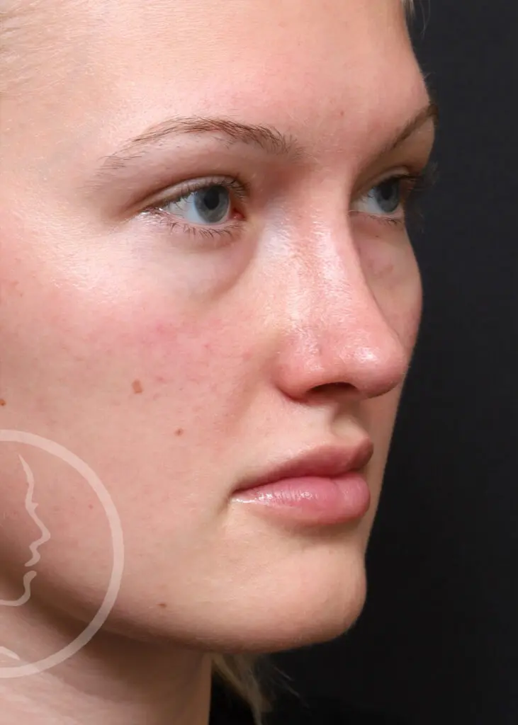 Plastic Surgery Before and After Pictures in Jacksonville, FL - Garcia Facial Plastic Surgery