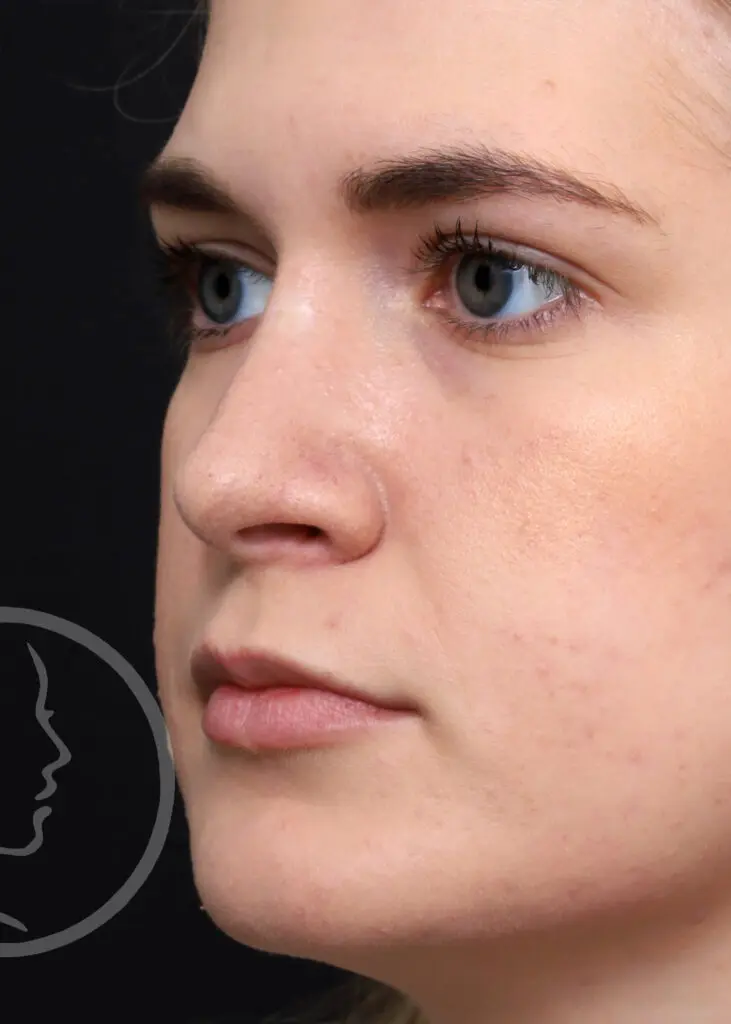 Plastic Surgery Before and After Pictures in Jacksonville, FL - Garcia Facial Plastic Surgery