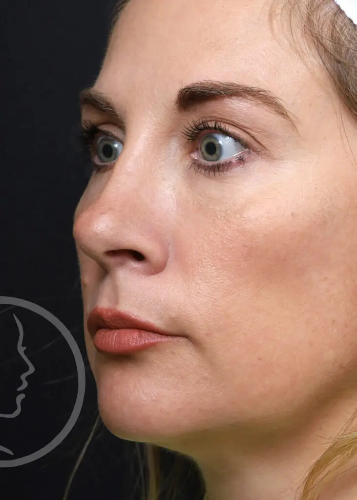 Plastic Surgery Before and After Pictures in Jacksonville, FL - Garcia Facial Plastic Surgery