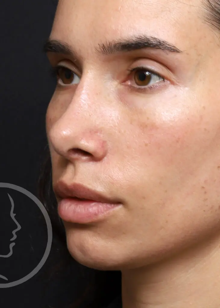 Plastic Surgery Before and After Pictures in Jacksonville, FL - Garcia Facial Plastic Surgery