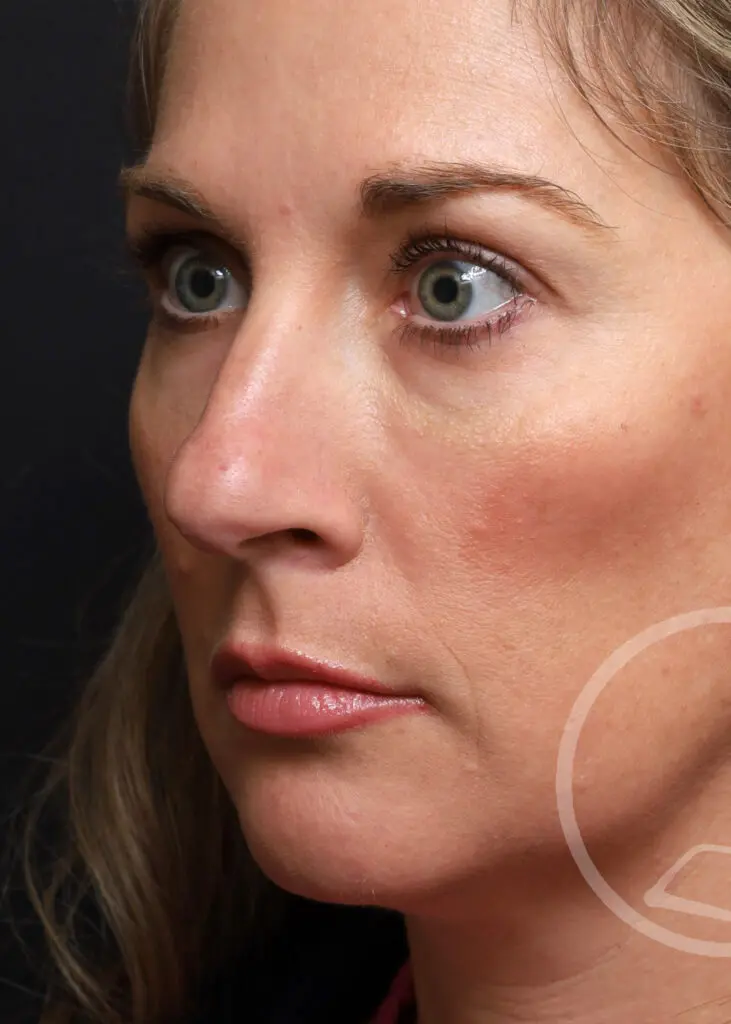 Plastic Surgery Before and After Pictures in Jacksonville, FL - Garcia Facial Plastic Surgery