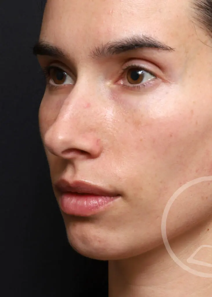 Plastic Surgery Before and After Pictures in Jacksonville, FL - Garcia Facial Plastic Surgery
