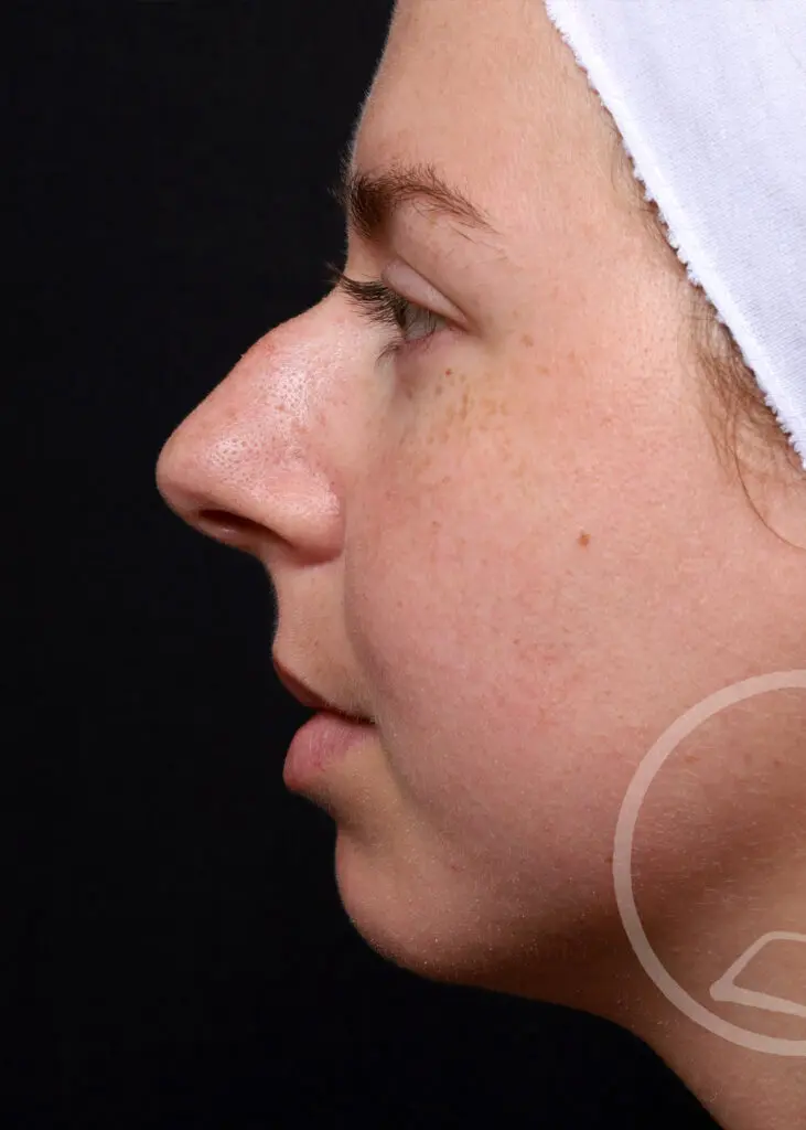Plastic Surgery Before and After Pictures in Jacksonville, FL - Garcia Facial Plastic Surgery