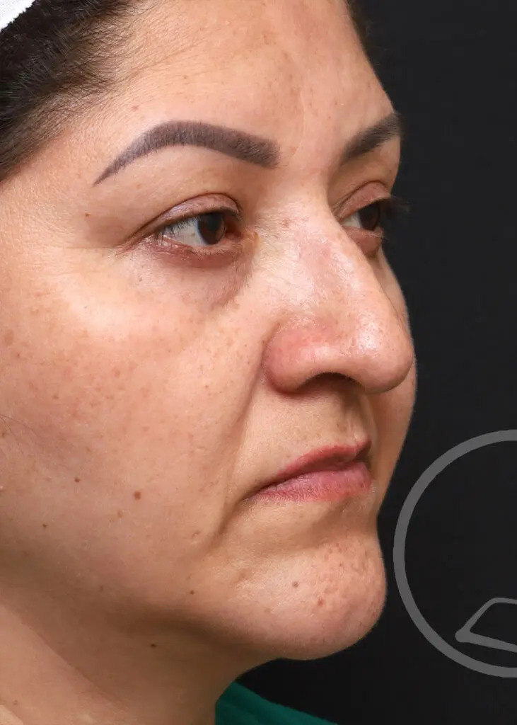 Plastic Surgery Before and After Pictures in Jacksonville, FL - Garcia Facial Plastic Surgery