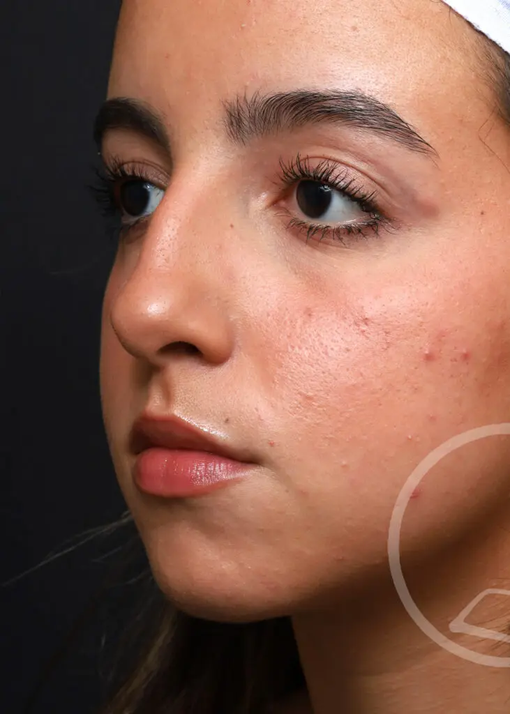 Plastic Surgery Before and After Pictures in Jacksonville, FL - Garcia Facial Plastic Surgery