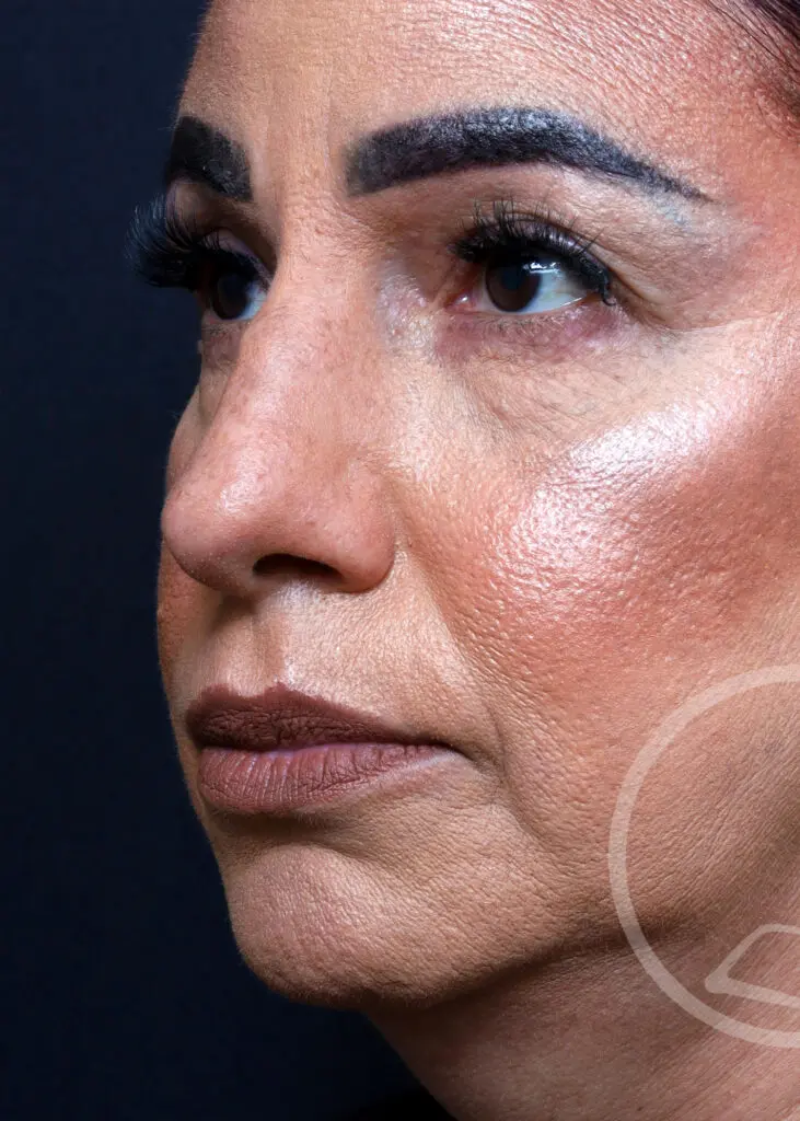 Plastic Surgery Before and After Pictures in Jacksonville, FL - Garcia Facial Plastic Surgery