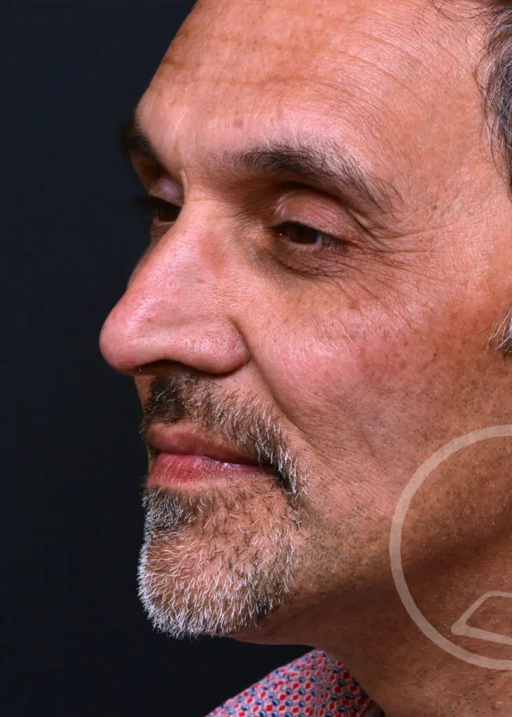 Plastic Surgery Before and After Pictures in Jacksonville, FL - Garcia Facial Plastic Surgery