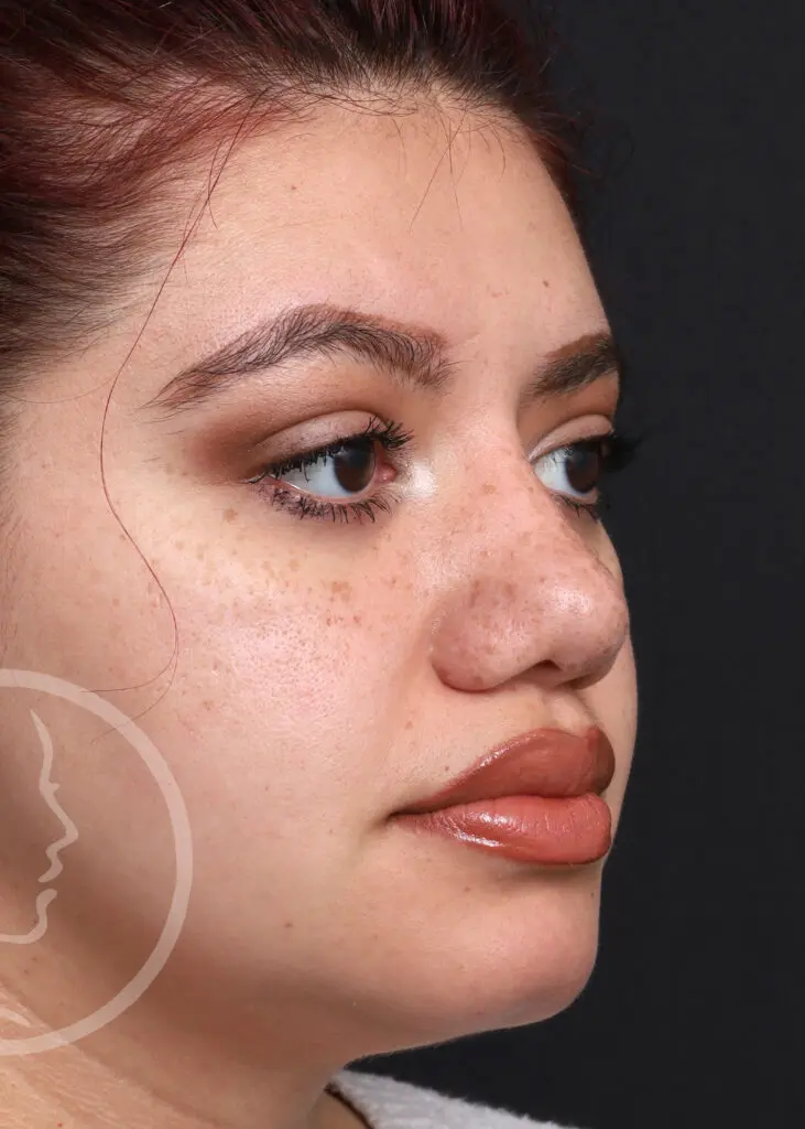 Plastic Surgery Before and After Pictures in Jacksonville, FL - Garcia Facial Plastic Surgery