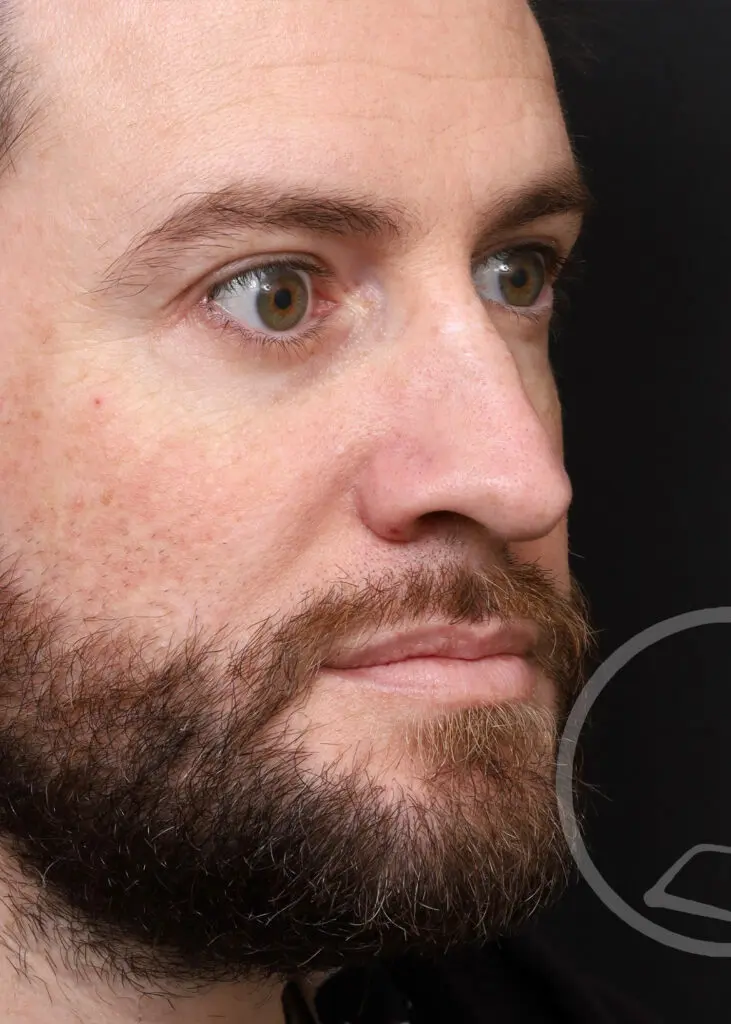 Plastic Surgery Before and After Pictures in Jacksonville, FL - Garcia Facial Plastic Surgery
