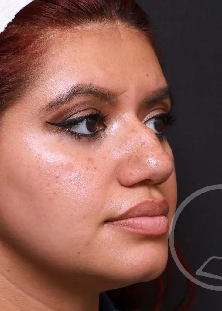 Plastic Surgery Before and After Pictures in Jacksonville, FL - Garcia Facial Plastic Surgery