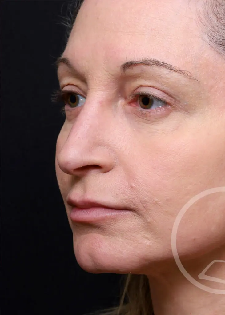 Plastic Surgery Before and After Pictures in Jacksonville, FL - Garcia Facial Plastic Surgery