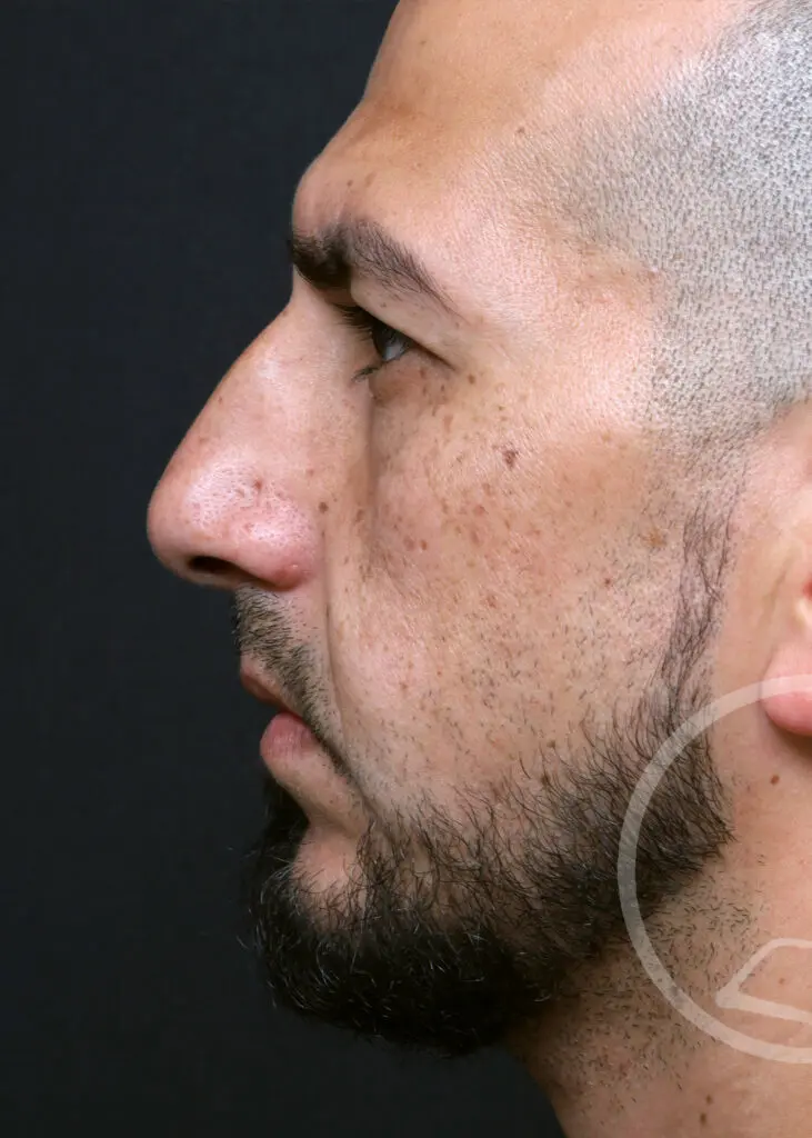 Plastic Surgery Before and After Pictures in Jacksonville, FL - Garcia Facial Plastic Surgery