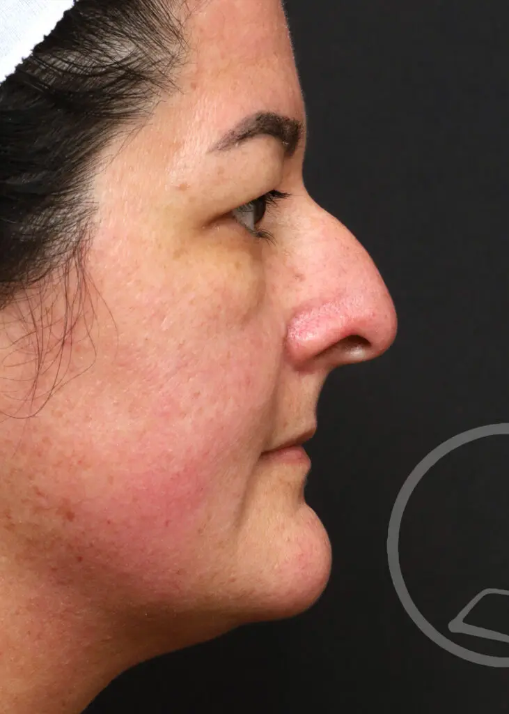 Plastic Surgery Before and After Pictures in Jacksonville, FL - Garcia Facial Plastic Surgery