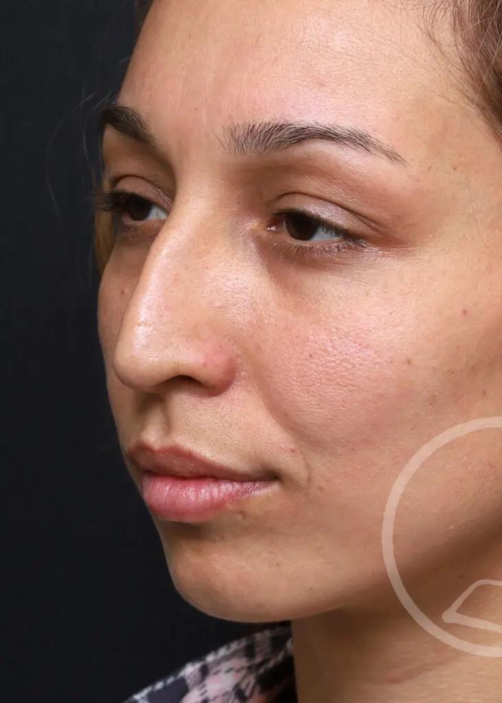 Plastic Surgery Before and After Pictures in Jacksonville, FL - Garcia Facial Plastic Surgery