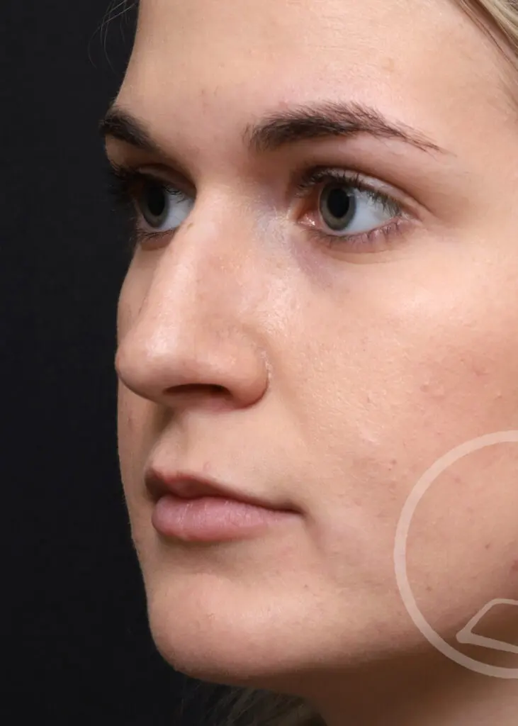 Plastic Surgery Before and After Pictures in Jacksonville, FL - Garcia Facial Plastic Surgery