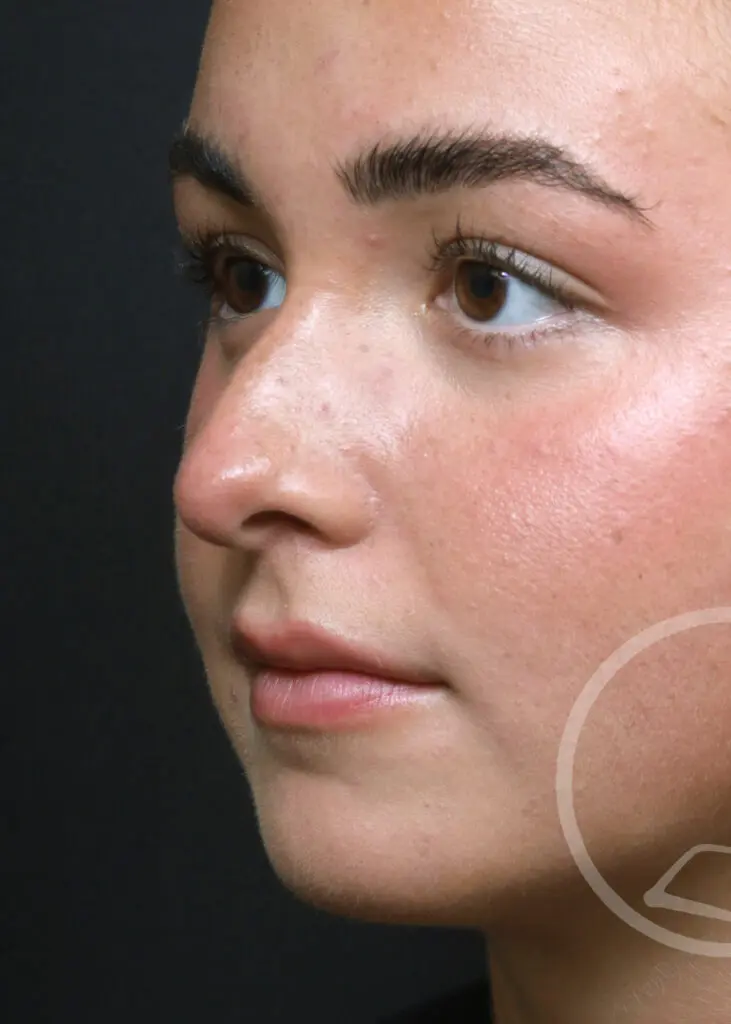 Plastic Surgery Before and After Pictures in Jacksonville, FL - Garcia Facial Plastic Surgery