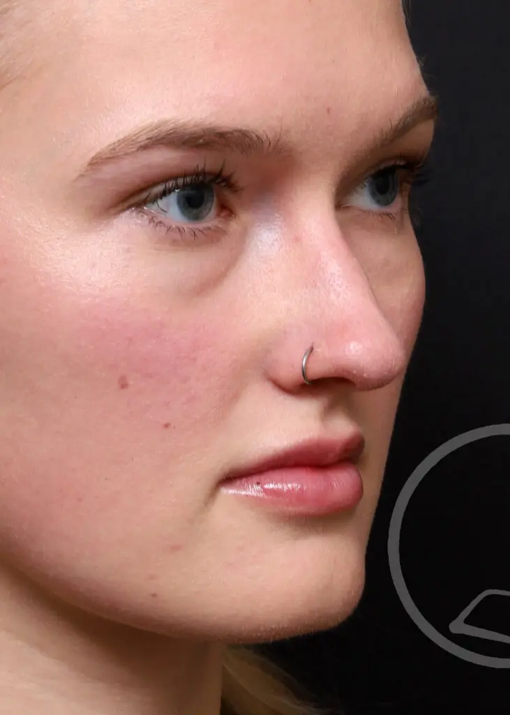 Plastic Surgery Before and After Pictures in Jacksonville, FL - Garcia Facial Plastic Surgery