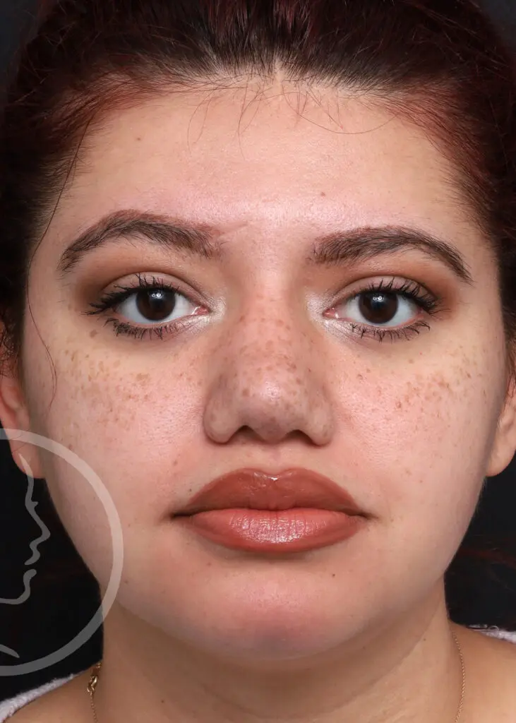 Plastic Surgery Before and After Pictures in Jacksonville, FL - Garcia Facial Plastic Surgery