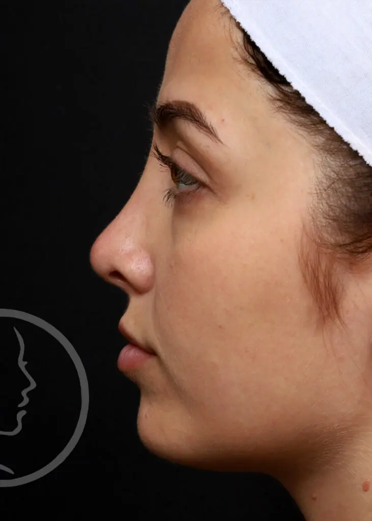 Plastic Surgery Before and After Pictures in Jacksonville, FL - Garcia Facial Plastic Surgery