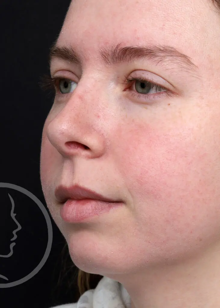 Plastic Surgery Before and After Pictures in Jacksonville, FL - Garcia Facial Plastic Surgery
