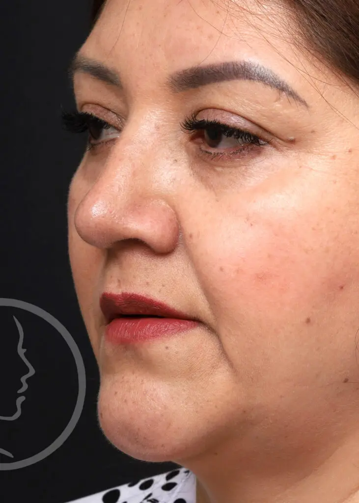 Plastic Surgery Before and After Pictures in Jacksonville, FL - Garcia Facial Plastic Surgery