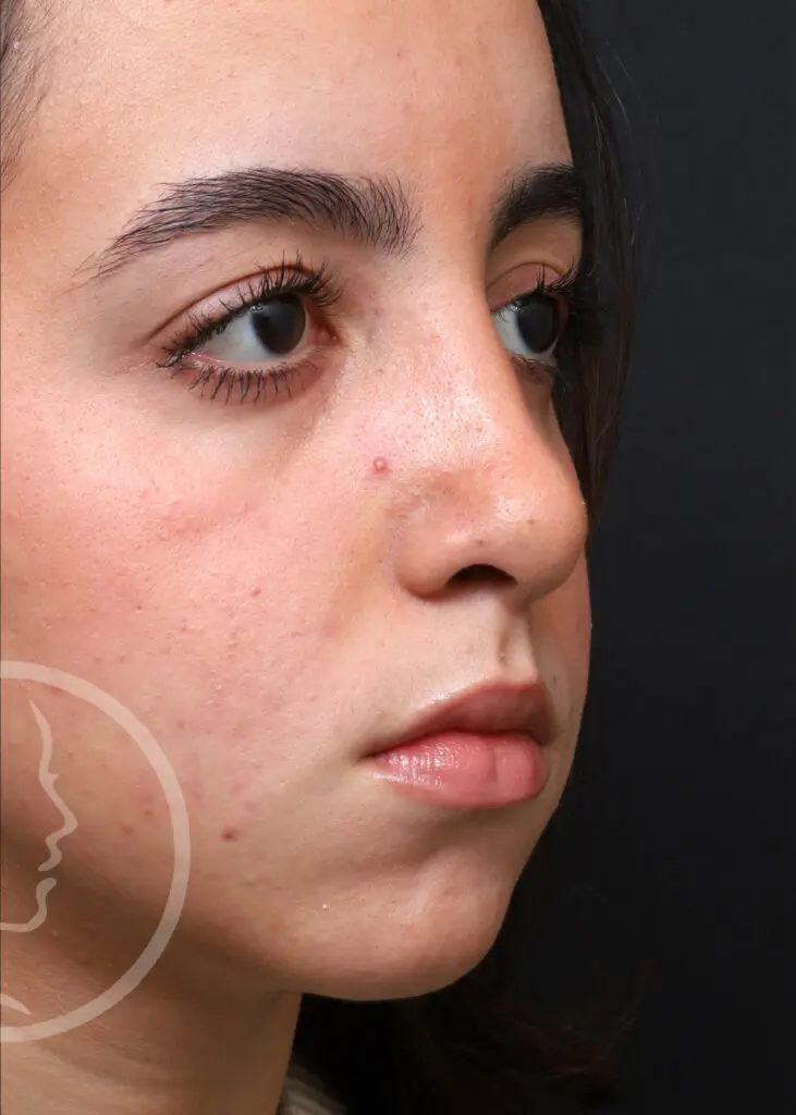 Plastic Surgery Before and After Pictures in Jacksonville, FL - Garcia Facial Plastic Surgery