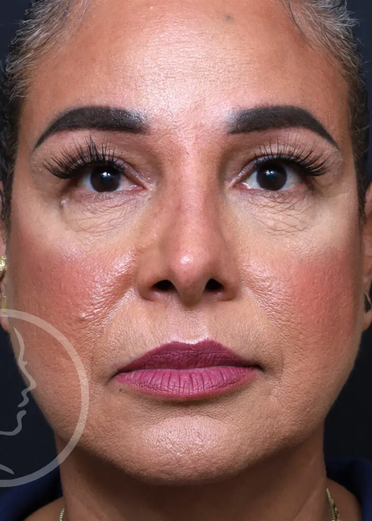 Plastic Surgery Before and After Pictures in Jacksonville, FL - Garcia Facial Plastic Surgery
