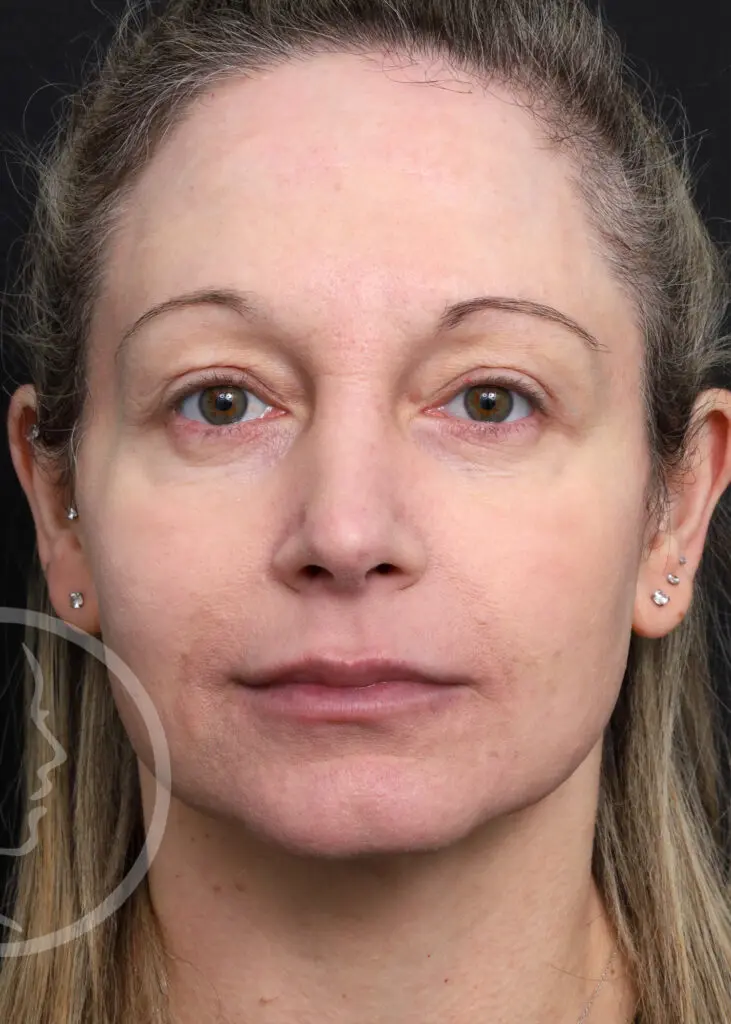 Plastic Surgery Before and After Pictures in Jacksonville, FL - Garcia Facial Plastic Surgery