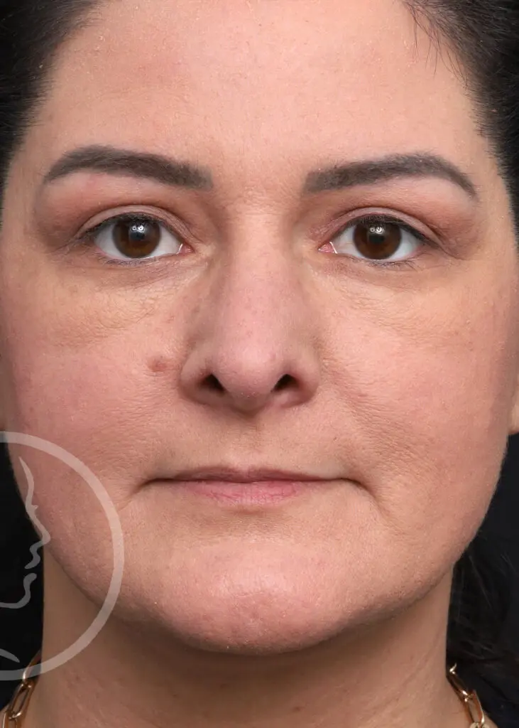 Plastic Surgery Before and After Pictures in Jacksonville, FL - Garcia Facial Plastic Surgery