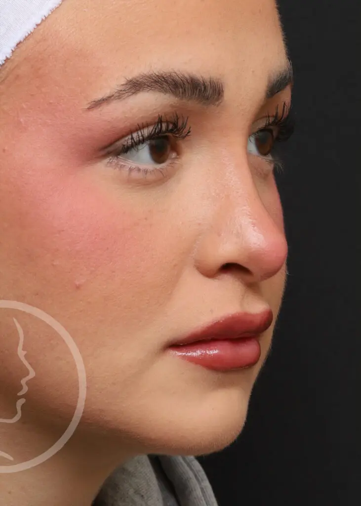 Plastic Surgery Before and After Pictures in Jacksonville, FL - Garcia Facial Plastic Surgery