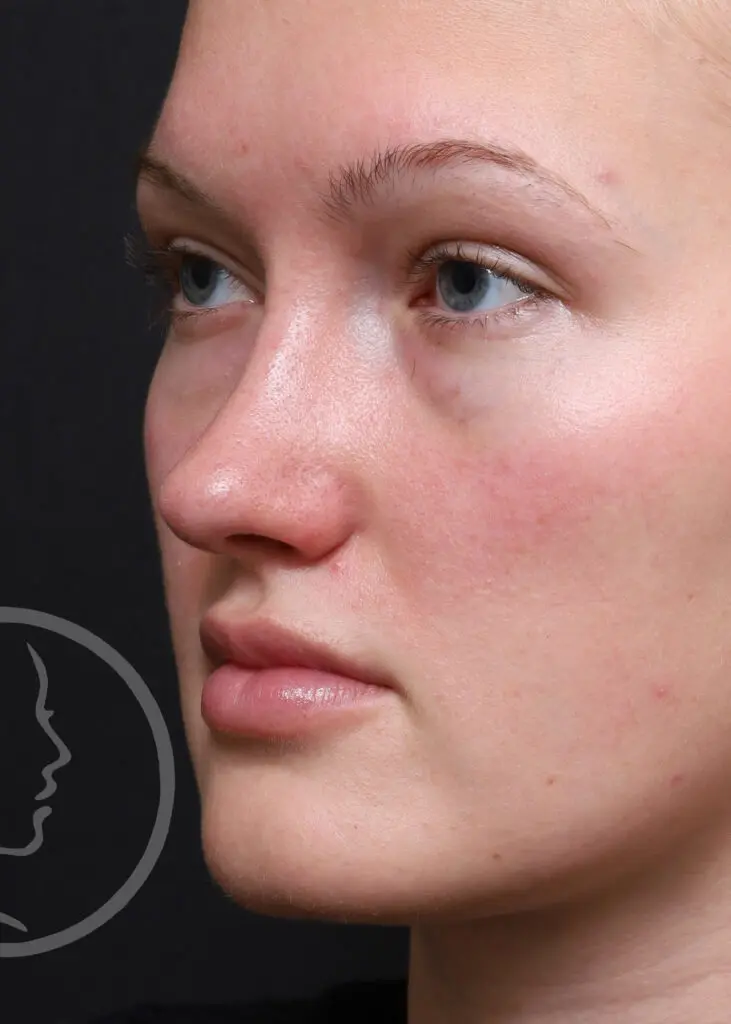 Plastic Surgery Before and After Pictures in Jacksonville, FL - Garcia Facial Plastic Surgery