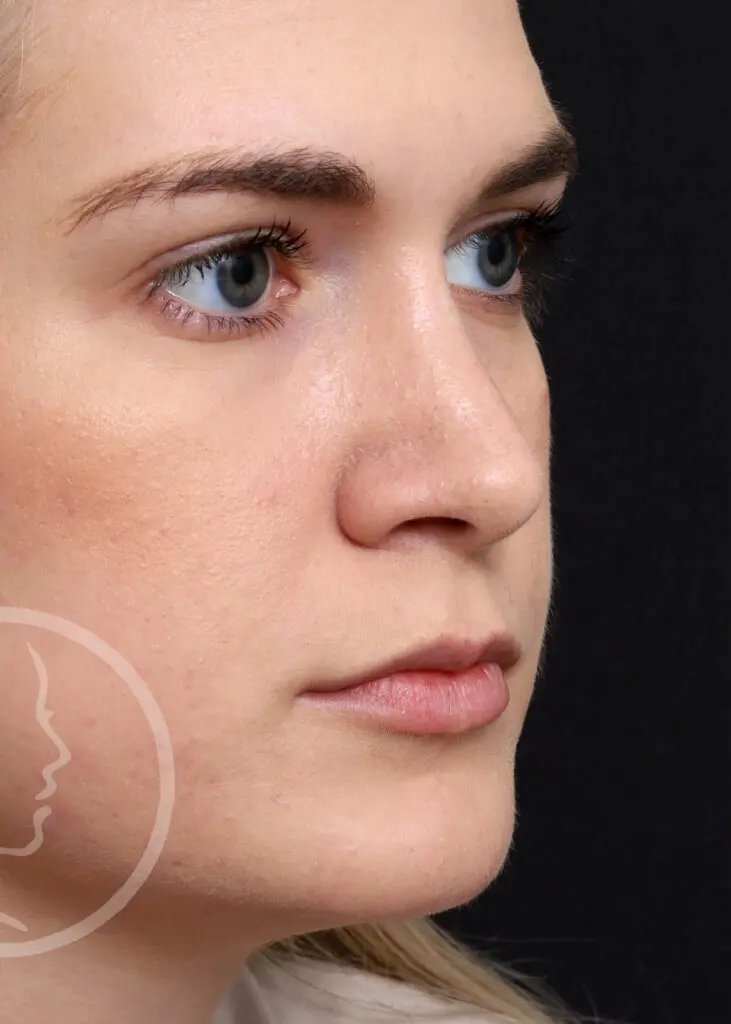 Plastic Surgery Before and After Pictures in Jacksonville, FL - Garcia Facial Plastic Surgery