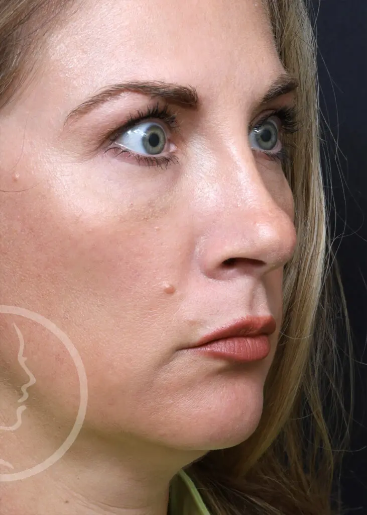 Plastic Surgery Before and After Pictures in Jacksonville, FL - Garcia Facial Plastic Surgery