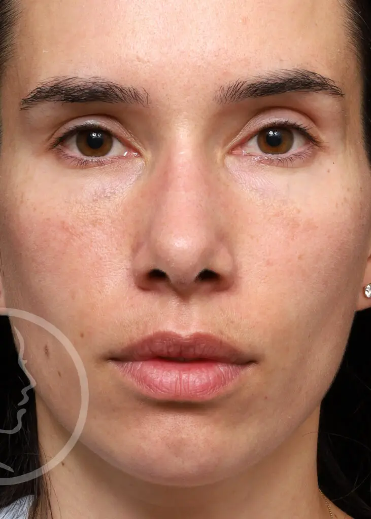 Plastic Surgery Before and After Pictures in Jacksonville, FL - Garcia Facial Plastic Surgery
