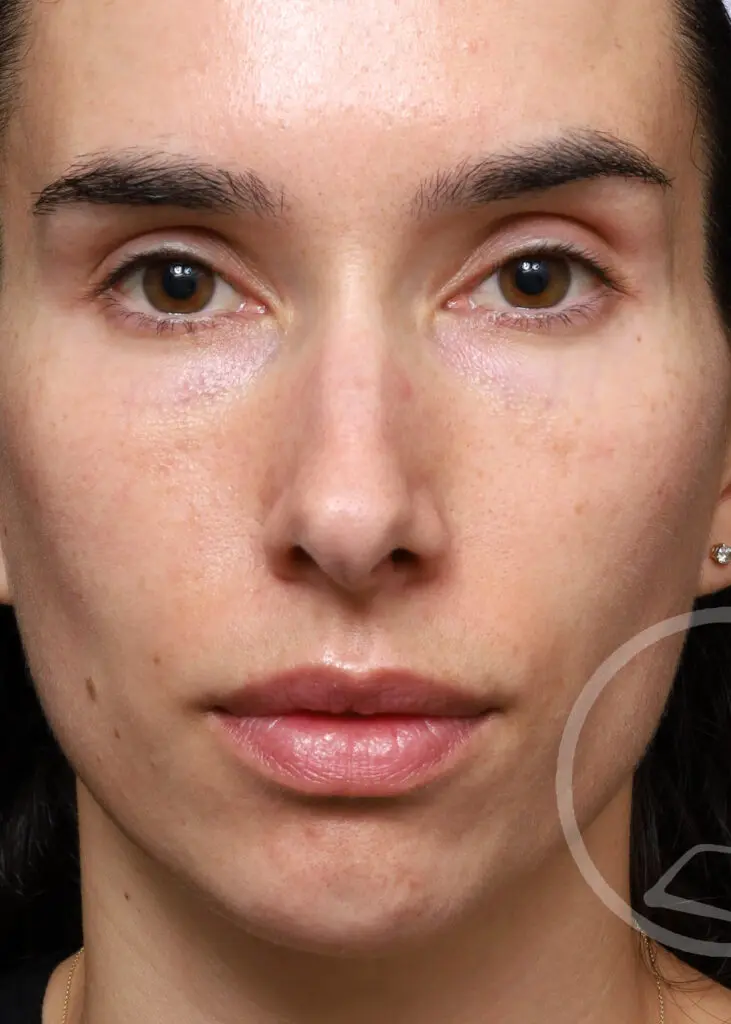 Plastic Surgery Before and After Pictures in Jacksonville, FL - Garcia Facial Plastic Surgery