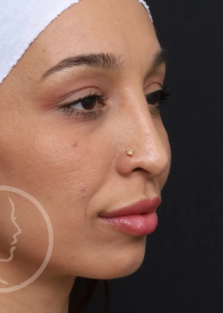 Plastic Surgery Before and After Pictures in Jacksonville, FL - Garcia Facial Plastic Surgery