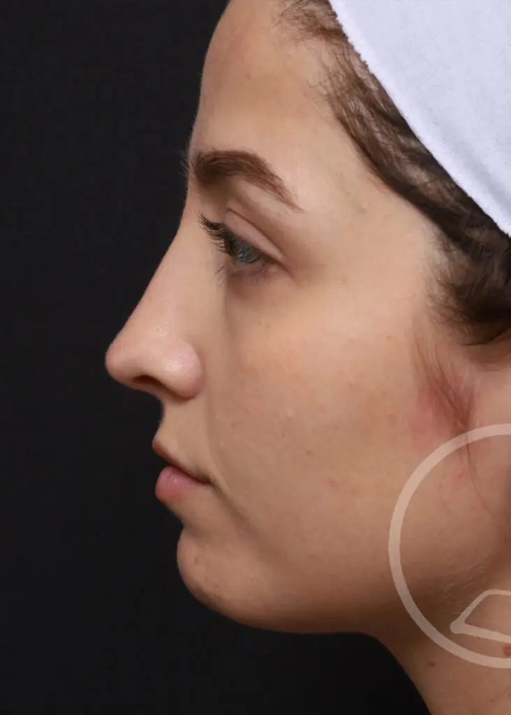 Plastic Surgery Before and After Pictures in Jacksonville, FL - Garcia Facial Plastic Surgery