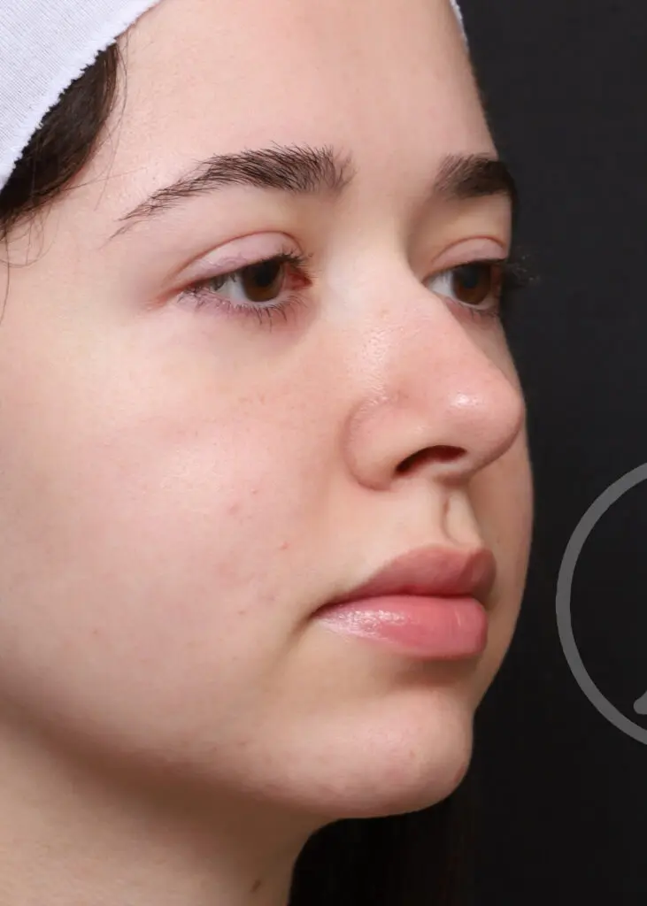 Plastic Surgery Before and After Pictures in Jacksonville, FL - Garcia Facial Plastic Surgery