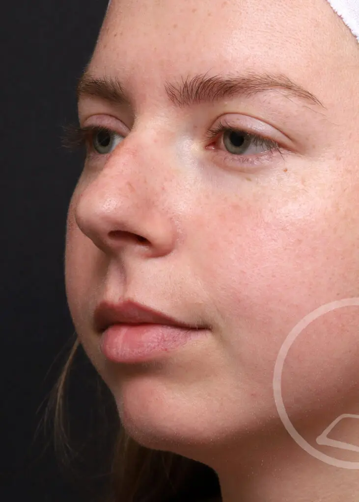 Plastic Surgery Before and After Pictures in Jacksonville, FL - Garcia Facial Plastic Surgery