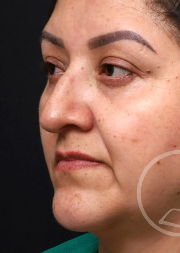 Plastic Surgery Before and After Pictures in Jacksonville, FL - Garcia Facial Plastic Surgery