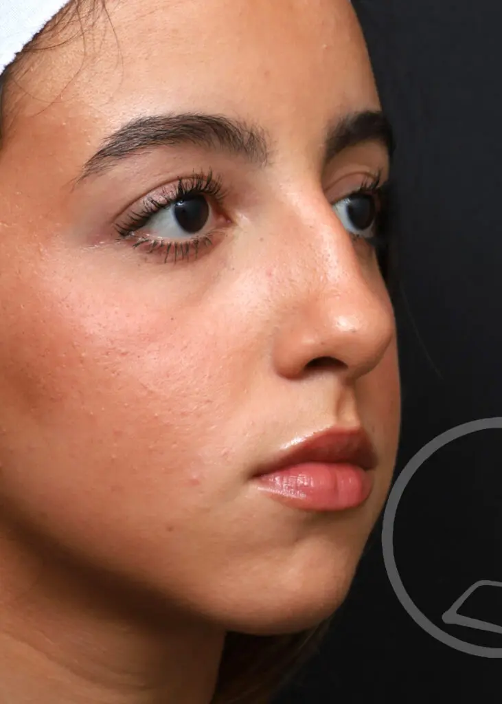 Plastic Surgery Before and After Pictures in Jacksonville, FL - Garcia Facial Plastic Surgery
