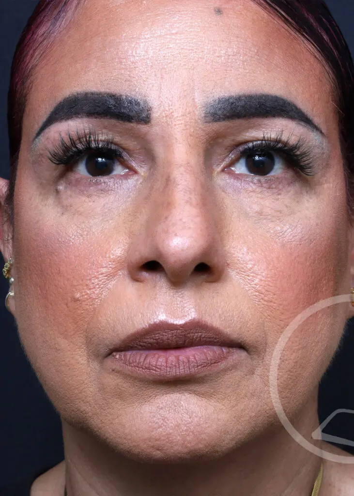 Plastic Surgery Before and After Pictures in Jacksonville, FL - Garcia Facial Plastic Surgery