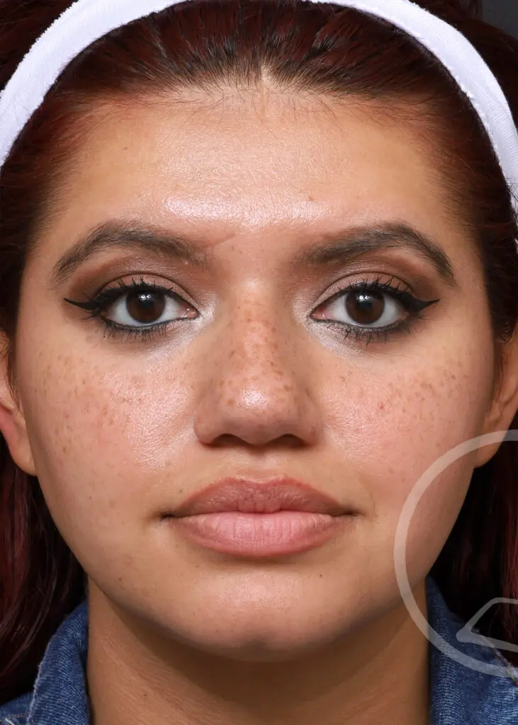 Plastic Surgery Before and After Pictures in Jacksonville, FL - Garcia Facial Plastic Surgery