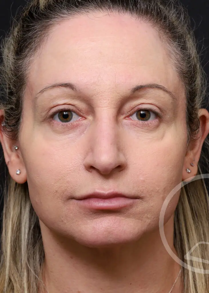 Plastic Surgery Before and After Pictures in Jacksonville, FL - Garcia Facial Plastic Surgery