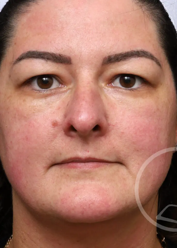 Plastic Surgery Before and After Pictures in Jacksonville, FL - Garcia Facial Plastic Surgery