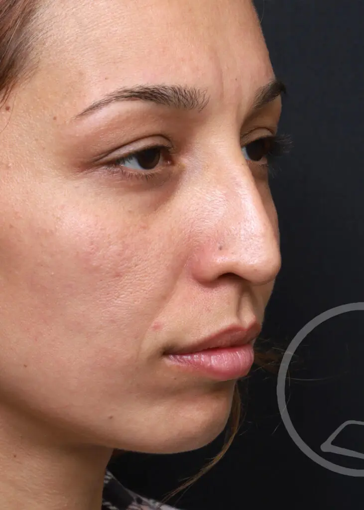Plastic Surgery Before and After Pictures in Jacksonville, FL - Garcia Facial Plastic Surgery