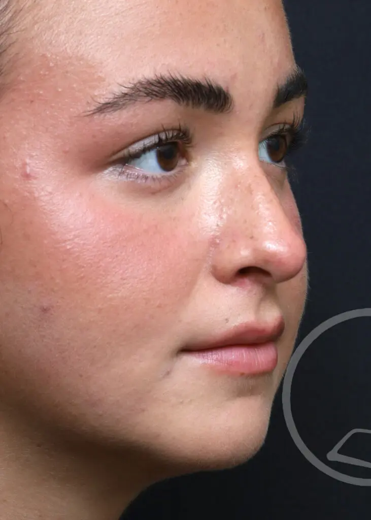 Plastic Surgery Before and After Pictures in Jacksonville, FL - Garcia Facial Plastic Surgery