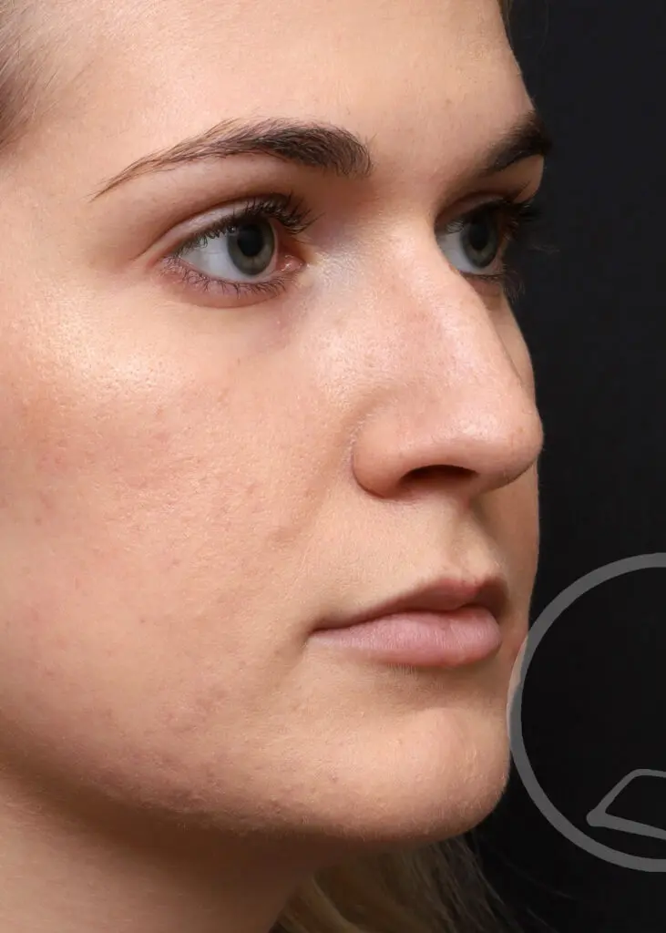 Plastic Surgery Before and After Pictures in Jacksonville, FL - Garcia Facial Plastic Surgery