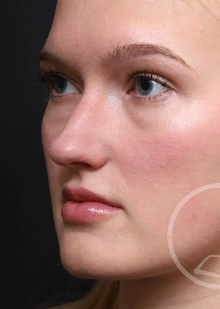 Plastic Surgery Before and After Pictures in Jacksonville, FL - Garcia Facial Plastic Surgery