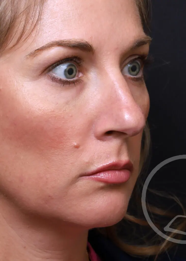 Plastic Surgery Before and After Pictures in Jacksonville, FL - Garcia Facial Plastic Surgery